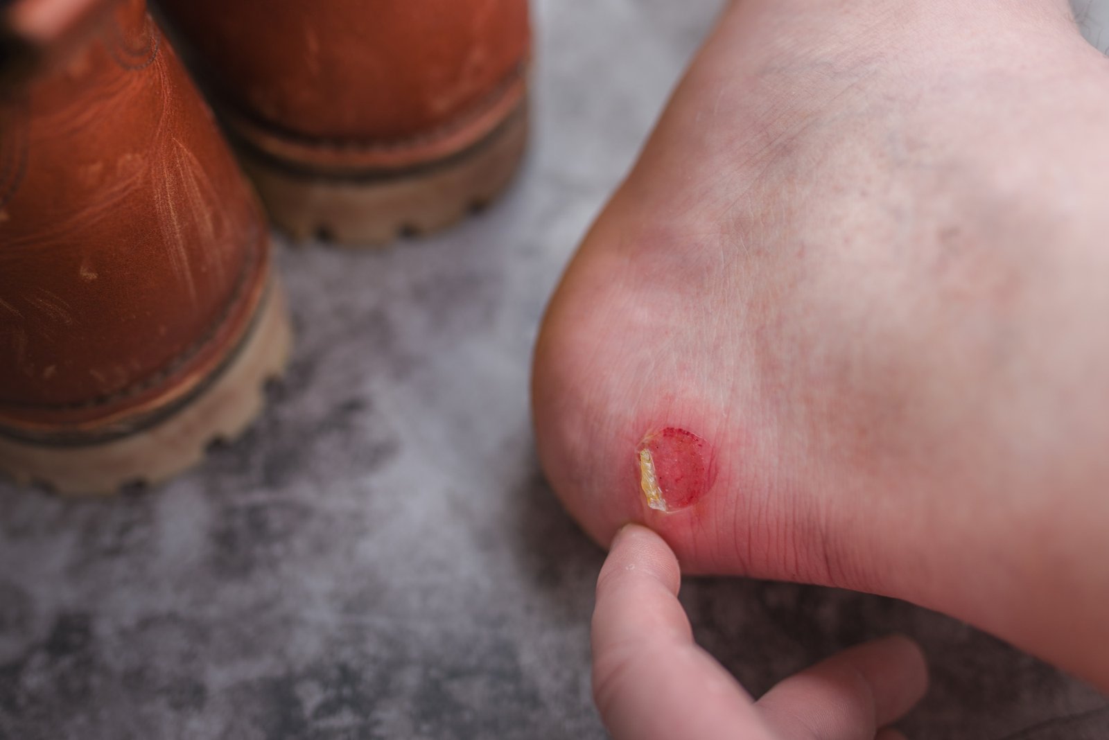Schuh reibt an der Ferse und verursacht Schmerzen